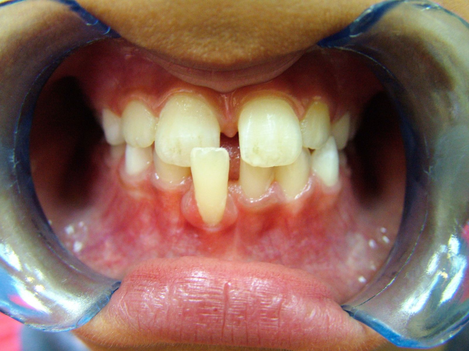 image of child needing early orthodontic intervention 