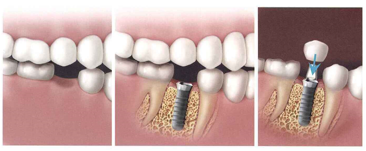 Picture of implant stages